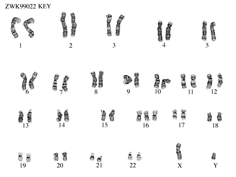 Пересадка хромосом. Хромосомная патология трисомия хромосомы 16. Синдром Патау трисомия по 13 хромосоме кариотип. Трисомия 16 хромосомы синдром. Кариотип при синдроме Патау.