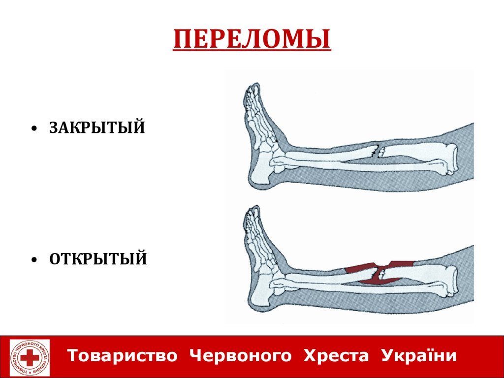 Открытая трещина. Переломы костей закрытый открытый. Перелом ноги открытый перелом. Открытый перелом схема. Открытый и закрытый перелом схема.