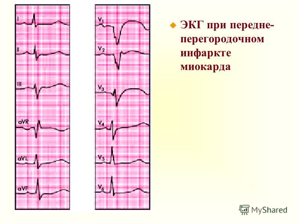 Изменение миокарда перегородочной области. Инфаркт переднеперегородочной области на ЭКГ. Передне-перегородочный инфаркт миокарда на ЭКГ. Инфаркт миокарда ЭКГ передней стенки q. ЭКГ передне перегородочный инфаркт миокарда левого желудочка.