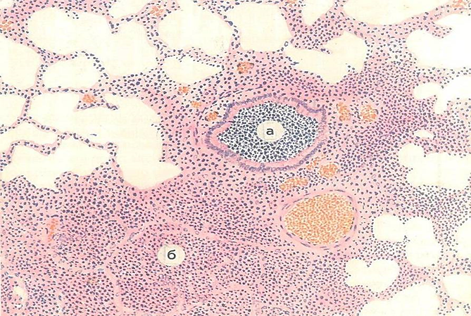 Какой микропрепарат изображен на рисунке. Коревая пневмония гистология. Патанатомия микропрепараты атлас. Бронхопневмония гистология. Бронхопневмония патанатомия макропрепарат.