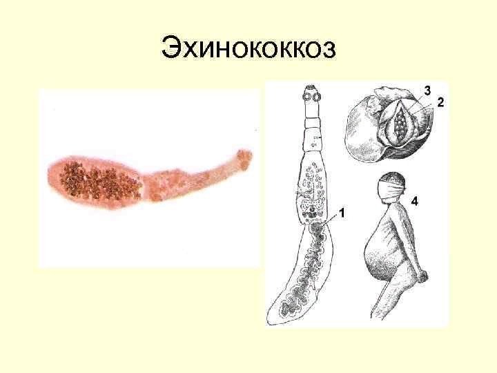 Ленточный червь эхинококк