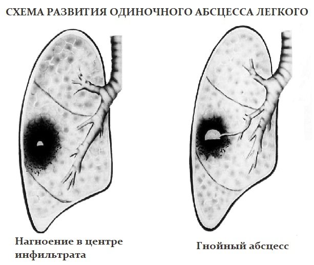 Острый абсцесс легкого клинические рекомендации