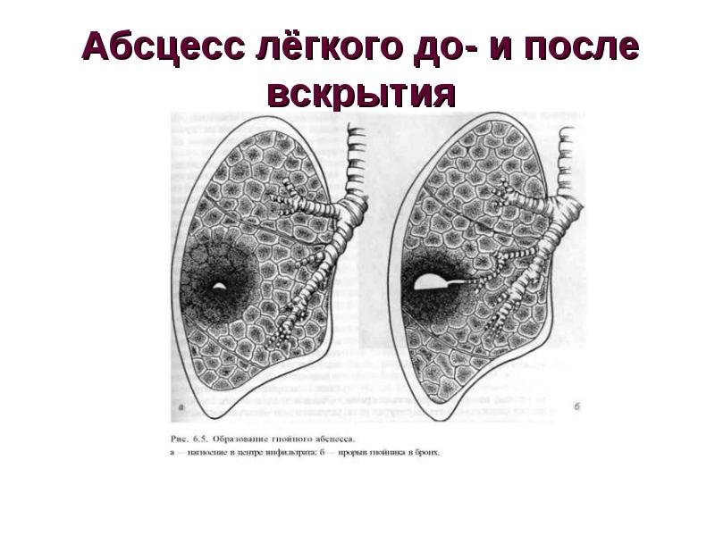 Дренирующийся абсцесс легкого