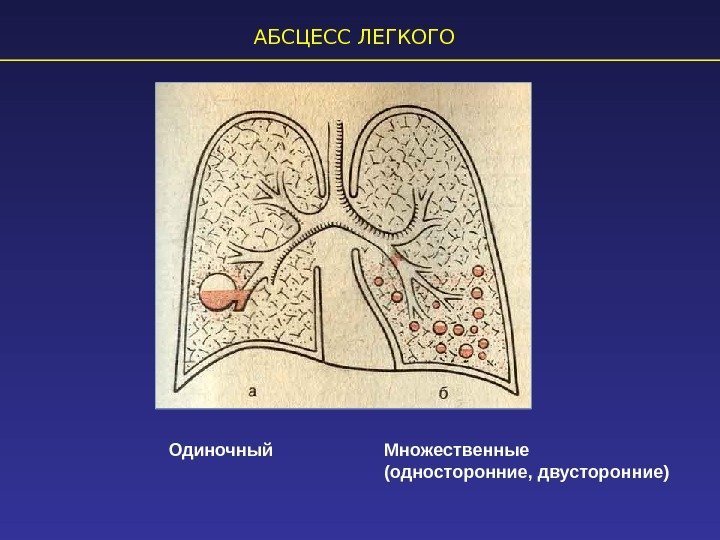 Центральный и периферический абсцесс легкого