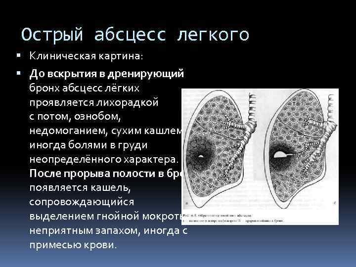 Абсцесс легкого