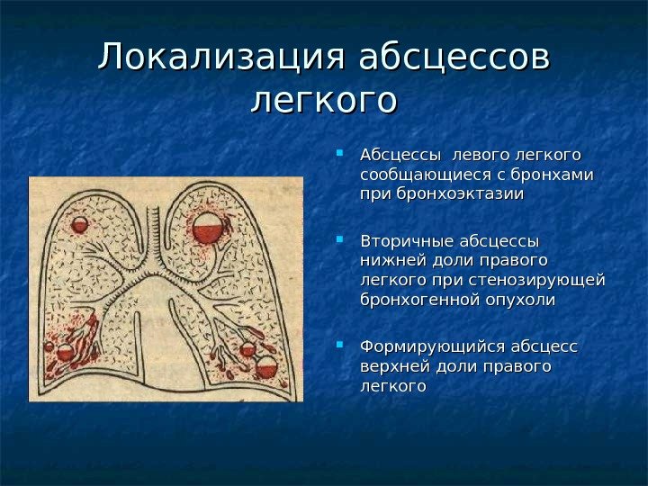 Абсцесс легкого бронхогенный путь