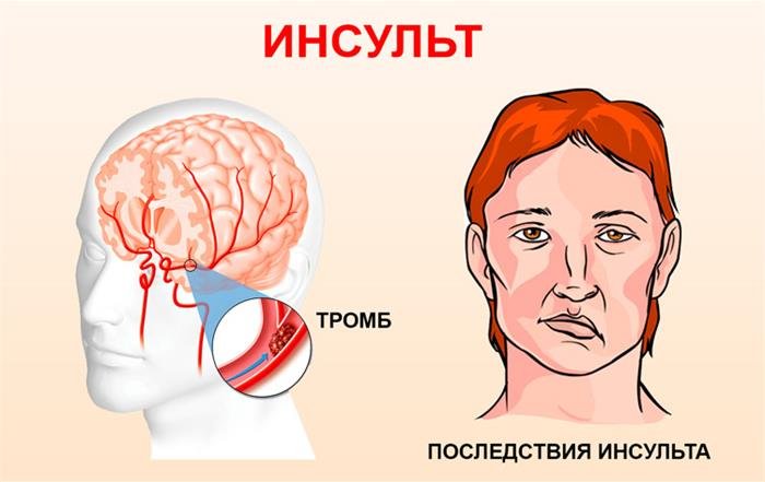 Инсульт рисунок