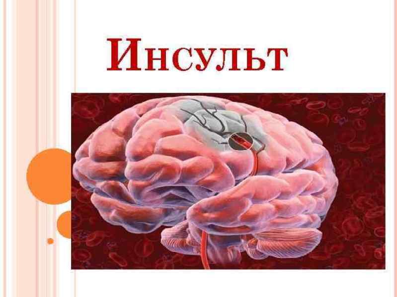 Презентация на тему инсульт