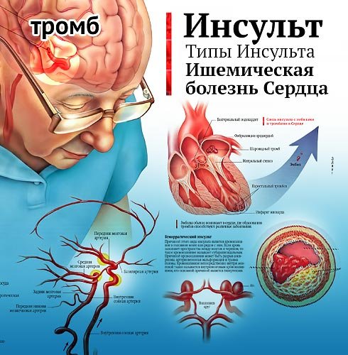 Ишемический сердечный инсульт
