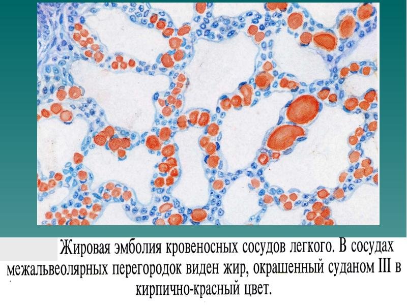 Жировая эмболия патанатомия