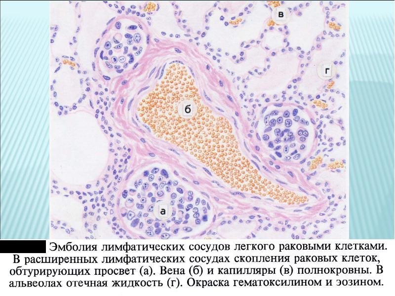 Клеточная эмболия сосудов лёгкого микропрепарат