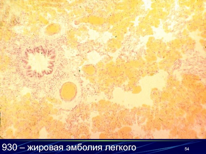 Микропрепарат жировая эмболия лёгкого