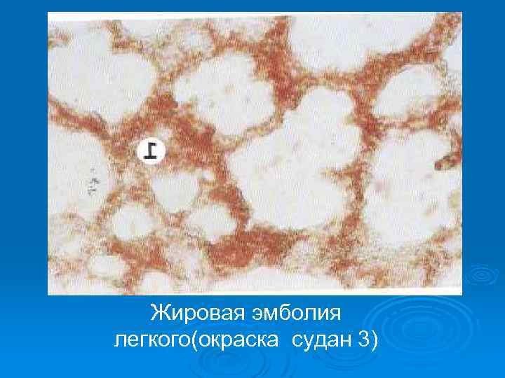 Жировая эмболия сосудов легкого (окраска Суданом 3-4).