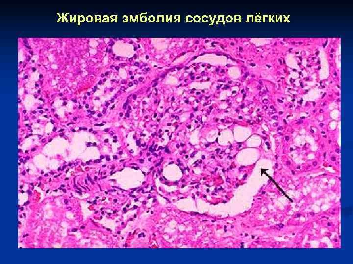 Воздушная эмболия гистология