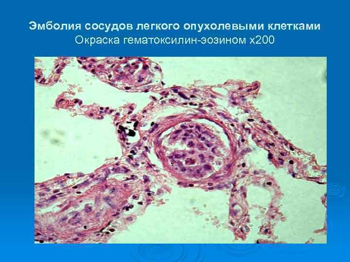 Тканевая эмболия сосудов легкого микропрепарат