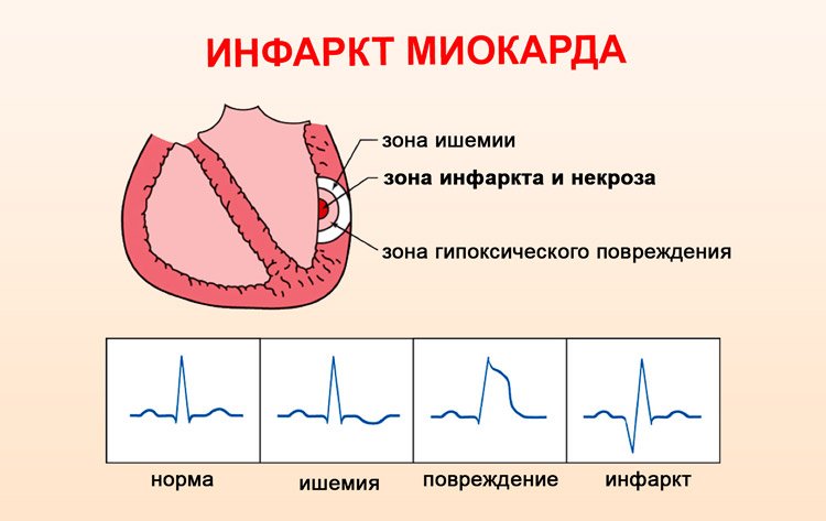 Что такое острый инфаркт миокарда сердца