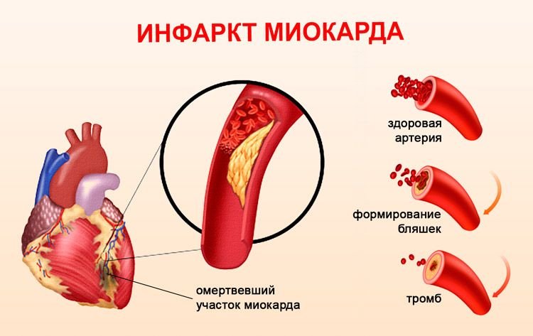 Инфаркт миокарда картинки