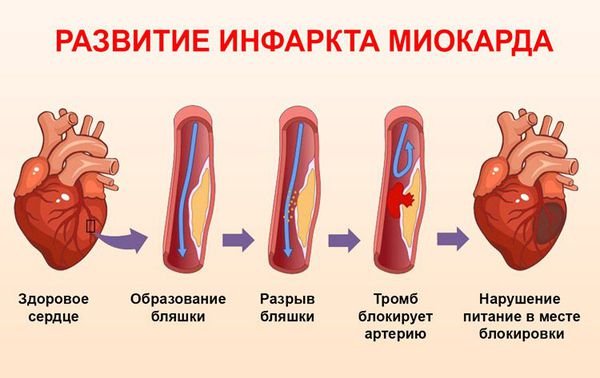 Процесс развития инфаркта миокарда