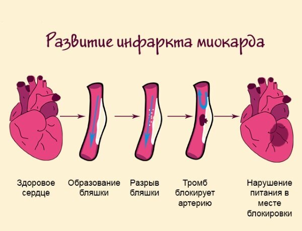Патогенез острого инфаркта миокарда кратко