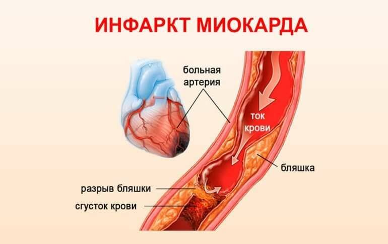 Инфаркт миокарда.инфаркт миокарда.