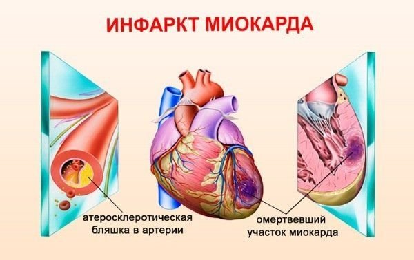 Сердце инфаркт миокарда