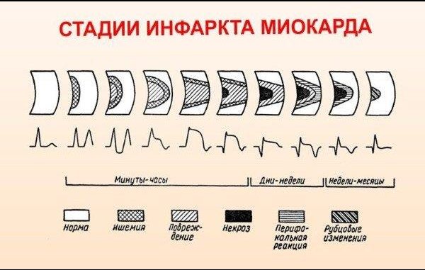 Этапы развития инфаркта миокарда