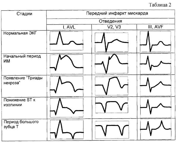ЭКГ критерии острой стадии инфаркта миокарда