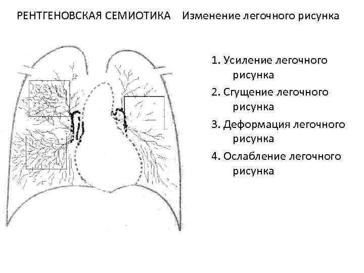 Деформация корней легочного рисунка