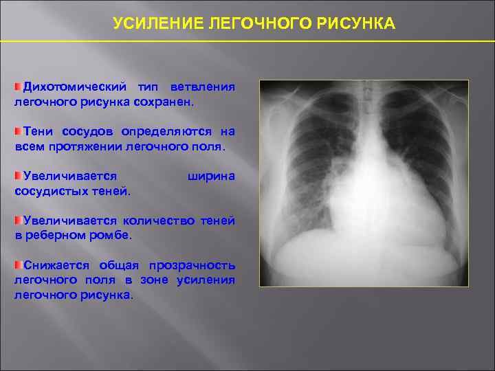 Обеднение легочного рисунка