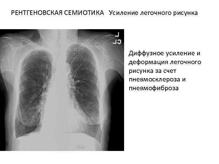Ячеистая деформация легочного рисунка рентген