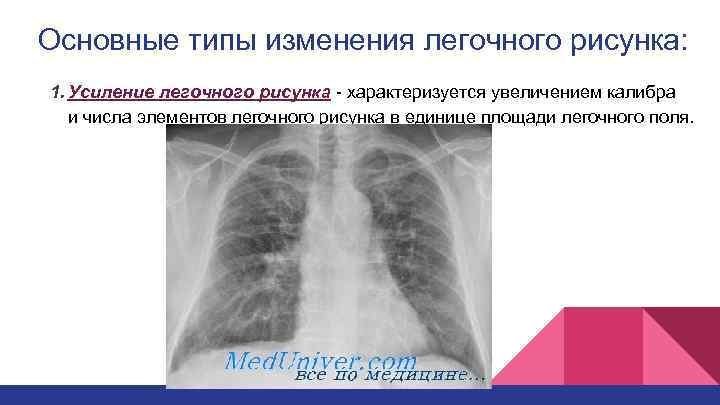 Изменение легочного рисунка