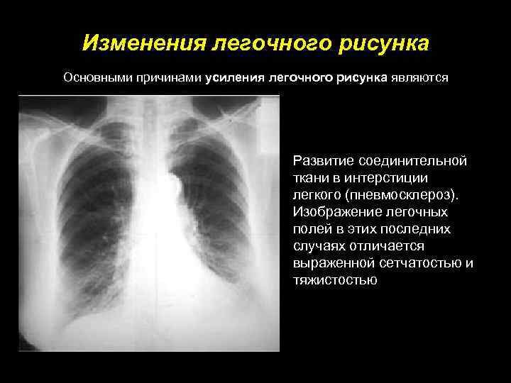 Изменение легочного рисунка