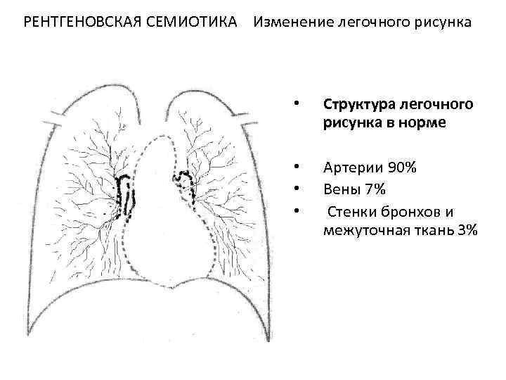 Легочный рисунок