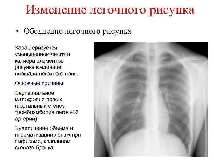 Обеднение легочного рисунка