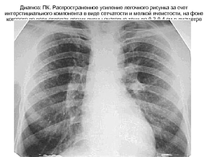 Усиление легочного рисунка за счет