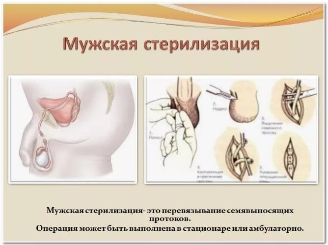 Хирургические методы контрацепции