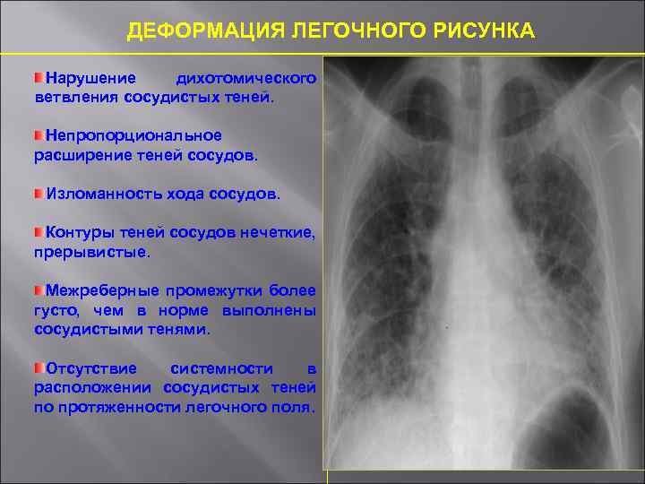 Легочный рисунок деформирован