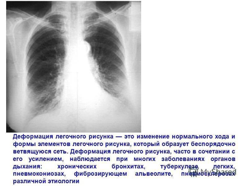 Рентген легких усиление легочного рисунка