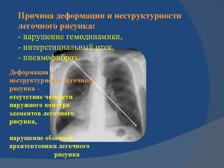 Легочный рисунок деформирован