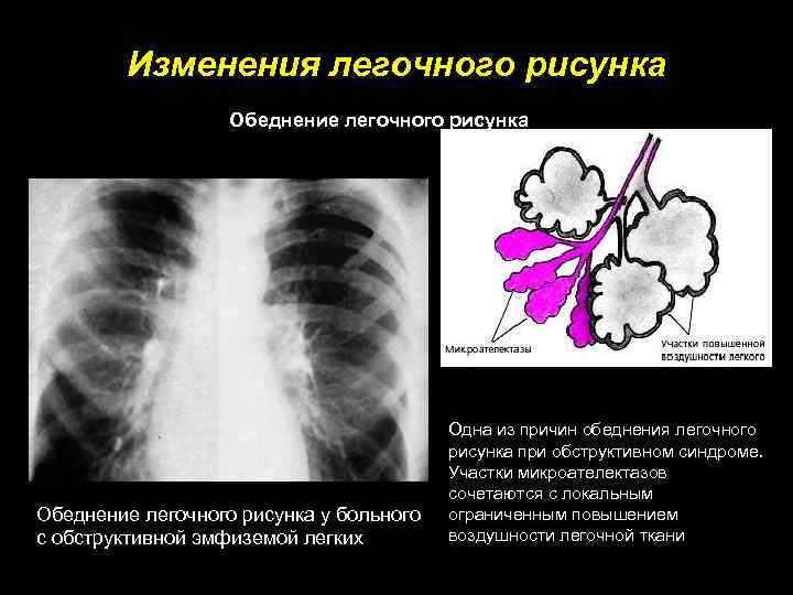 Синдром изменения легочного рисунка рентген