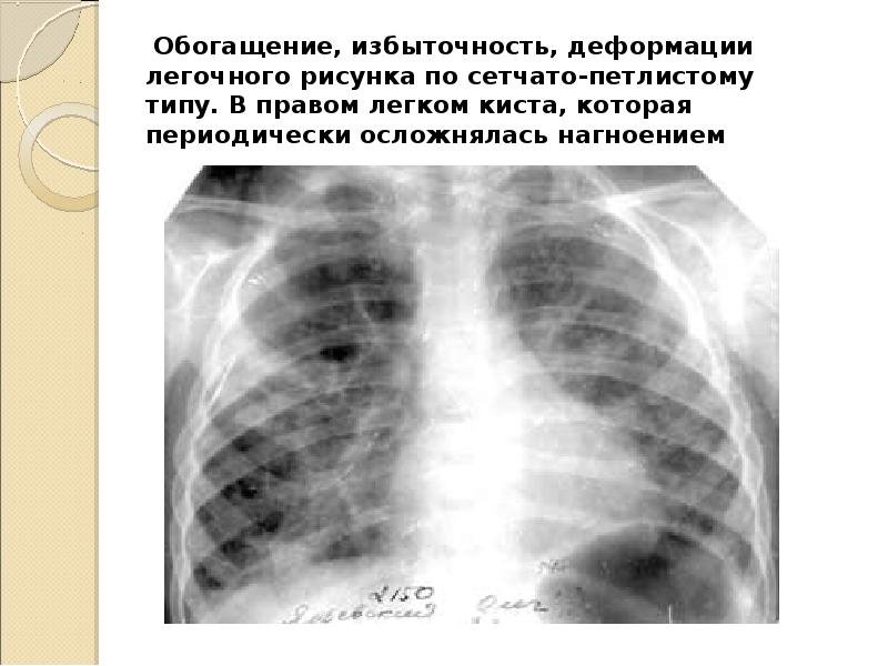 Легочный рисунок деформирован по сетчатому типу