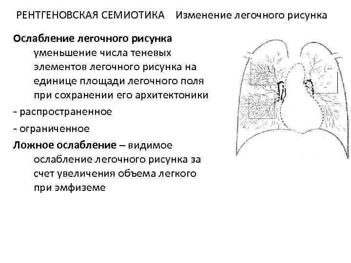 Синдром деформации легочного рисунка