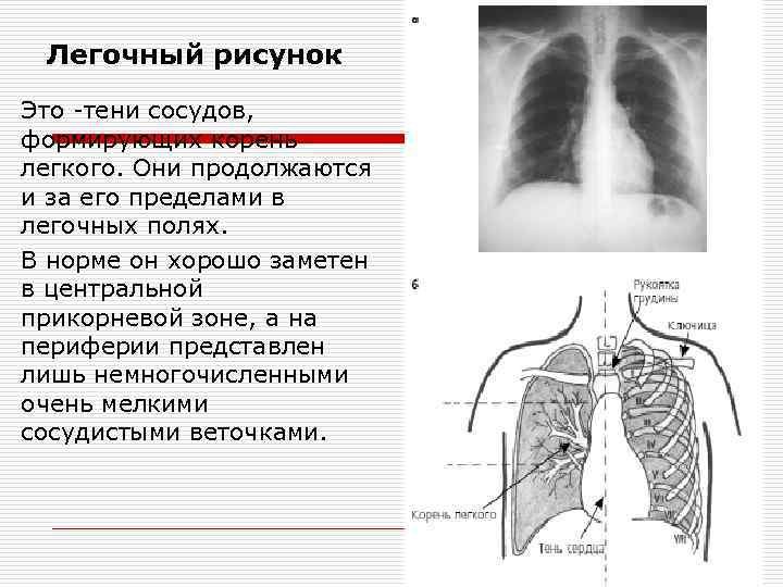 Легочный рисунок обеднен