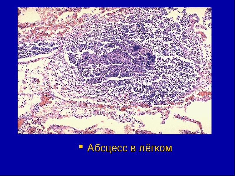 Метастатический абсцесс легкого препарат