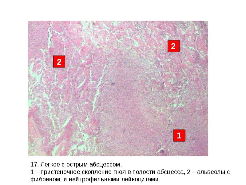 Острый абсцесс легкого микропрепарат