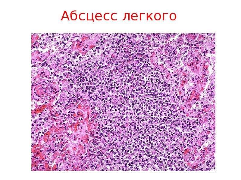Абсцесс патанатомия микропрепарат