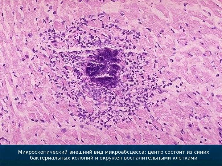 Метастатический абсцесс миокарда микропрепарат