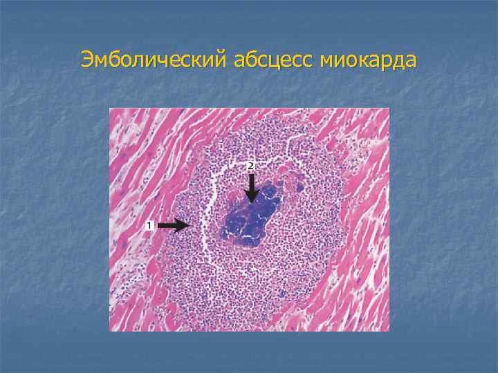 Абсцесс легкого микропрепарат
