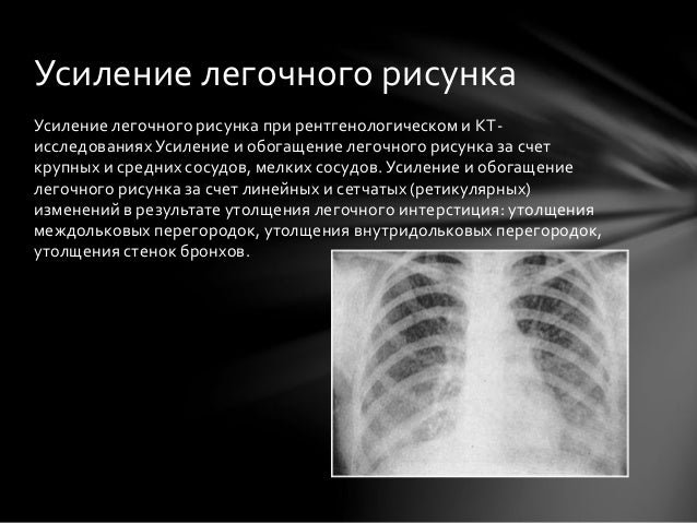 Деформация легочного рисунка