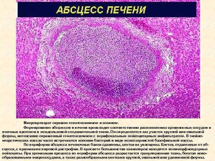 Хронический абсцесс гистология